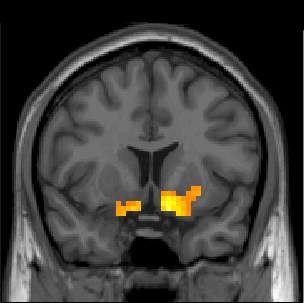 Statistical Parametric Map 
								of Ventral Striatum